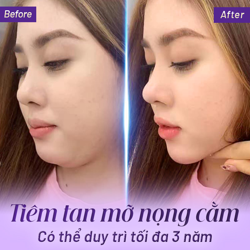 tiêm nọng cằm giá