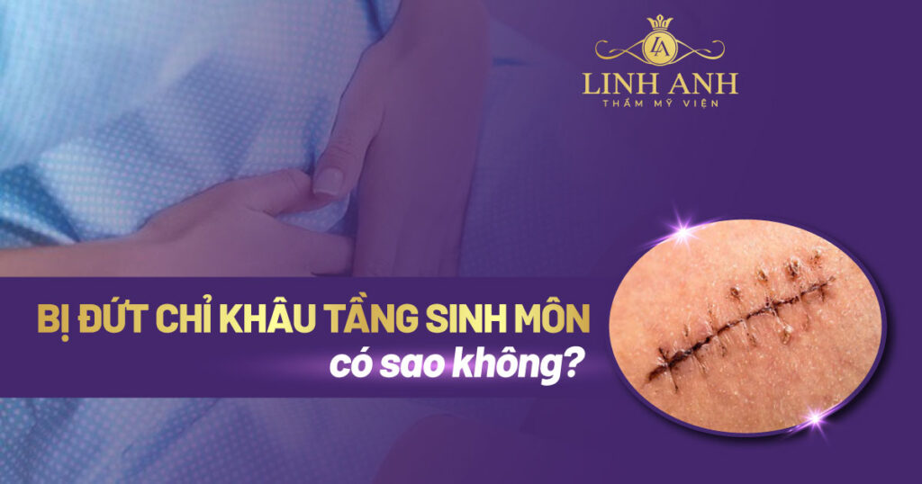 bị đứt chỉ khâu tầng sinh môn có sao không - Viện thẩm mỹ quốc tế Linh Anh