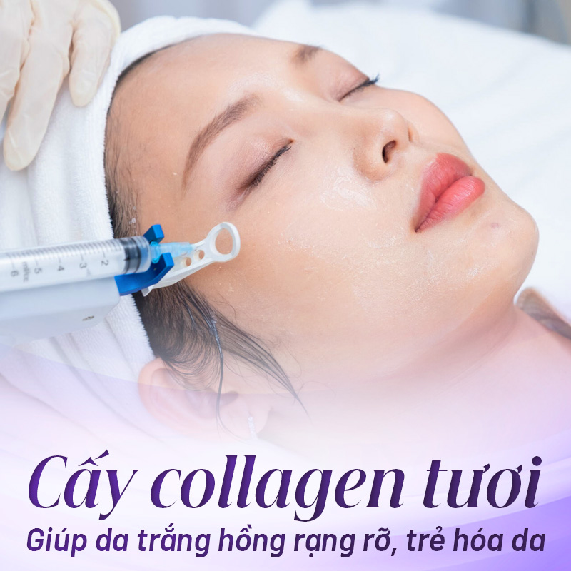 cấy trắng da mặt là gì