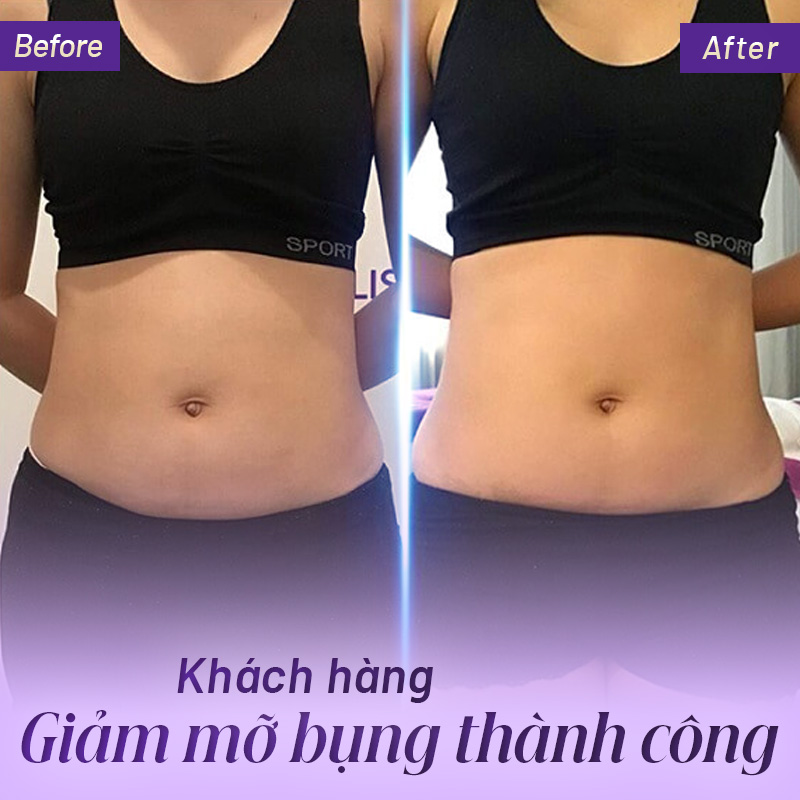 chi phí tiêm botox tan mỡ bụng