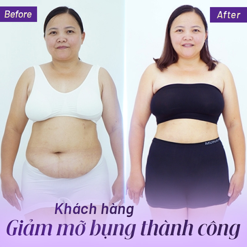 giá tiêm botox tan mỡ bụng