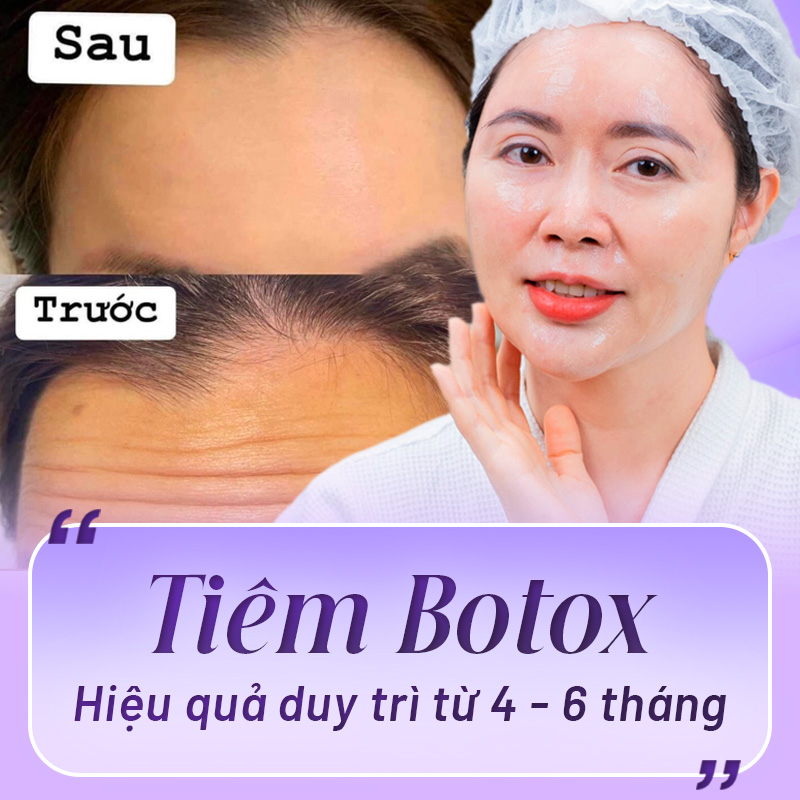 Botox là gì