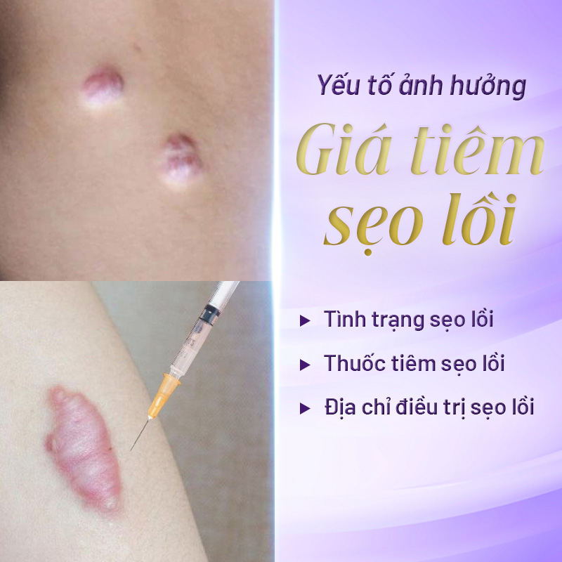 giá tiêm sẹo lồi