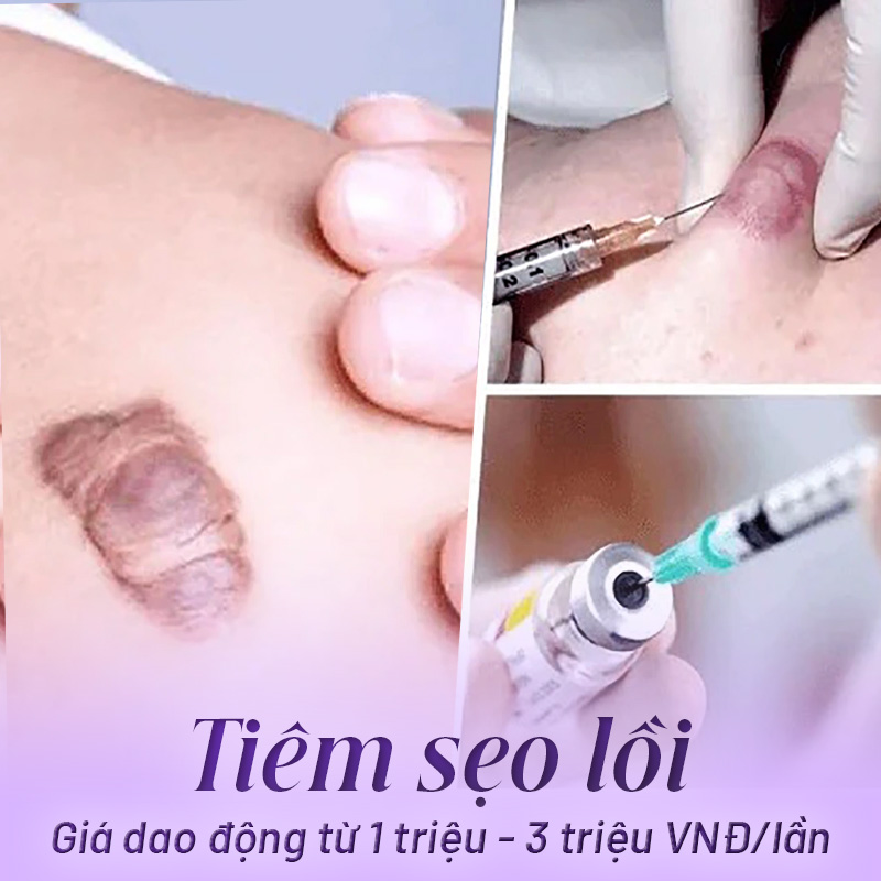 tiêm sẹo lồi giá