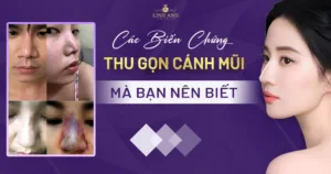 biến chứng thu gọn cánh mũi