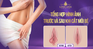 hình ảnh trước và sau khi cắt môi bé - Viện thẩm mỹ quốc tế Linh Anh