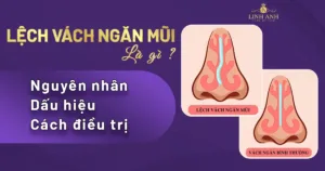 lệch vách ngăn mũi