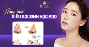 nâng mũi siêu sợi sinh học pdo