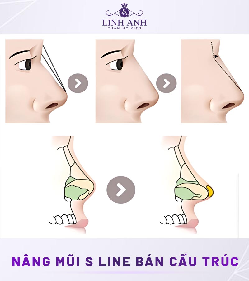 phẫu thuật nâng mũi s line