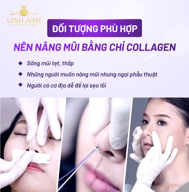 phương pháp nâng mũi bằng chỉ collagen