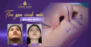 thu gọn cánh mũi bao nhiêu tiền