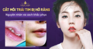 cắt môi trái tim bị hở răng