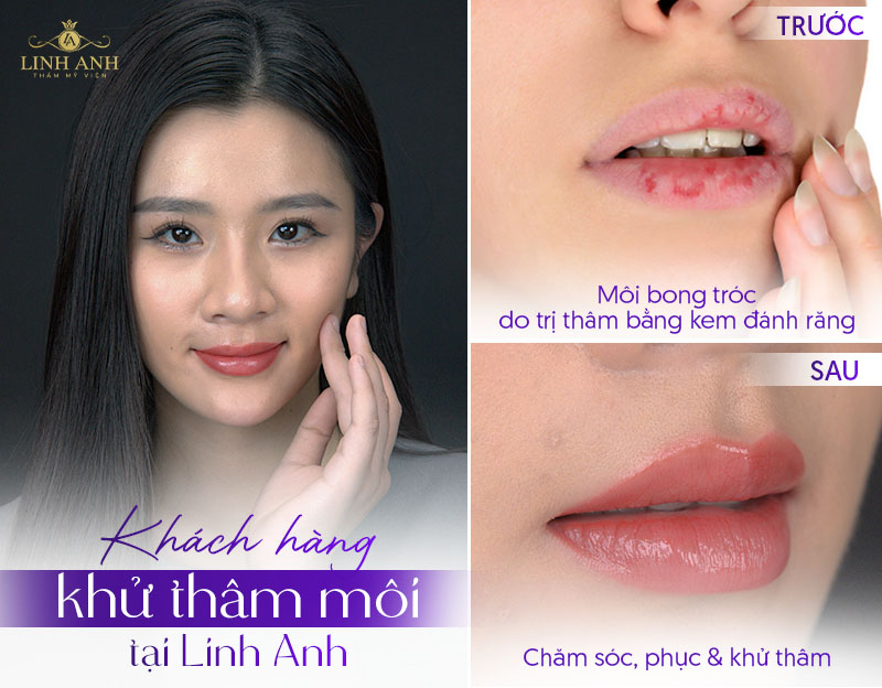làm môi hết Thâm sau 1 đêm có thật không