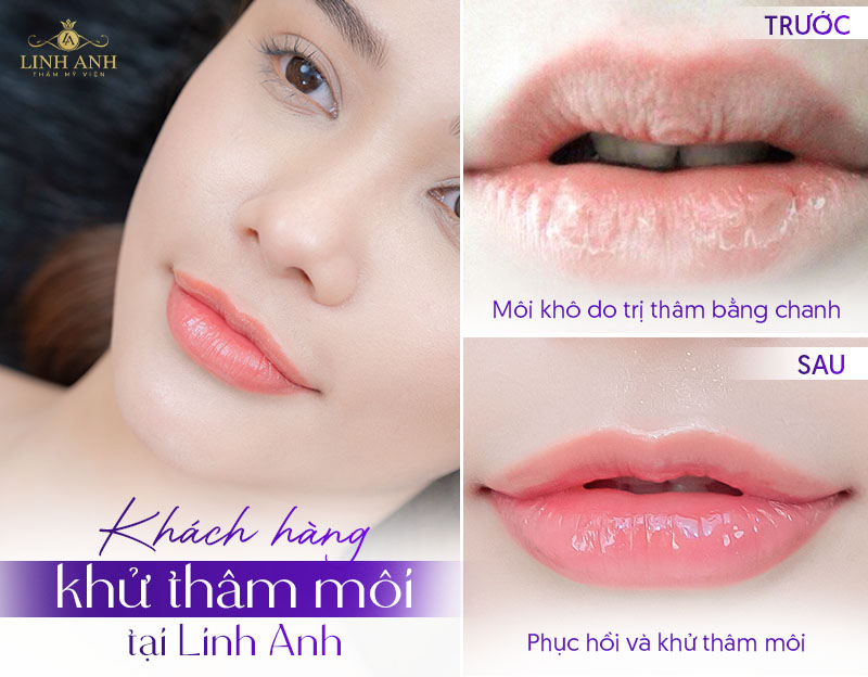 làm môi hết Thâm sau 1 đêm tại nhà
