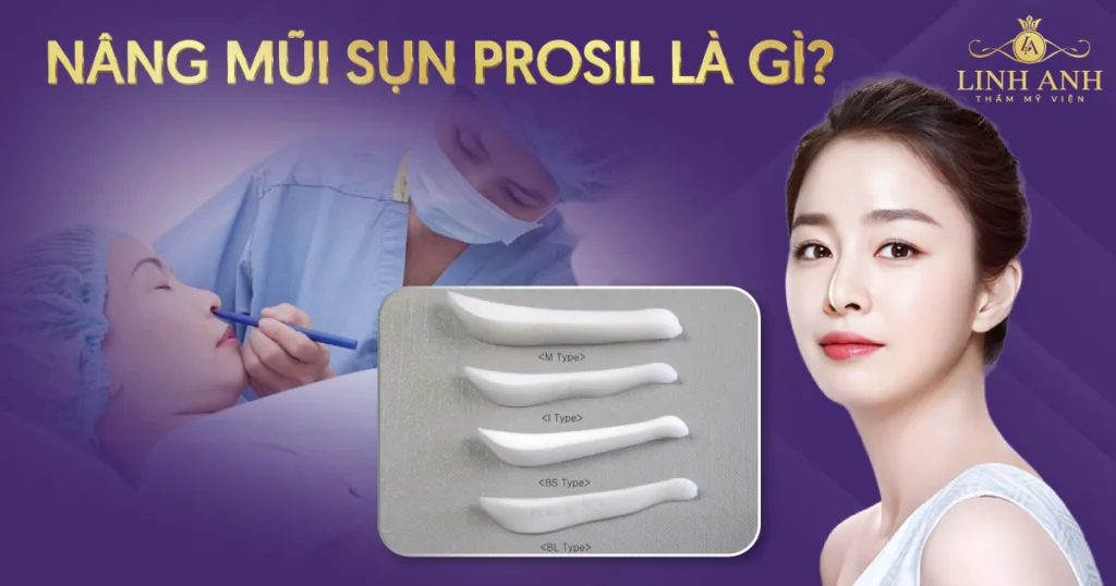 nâng mũi sụn prosil là gì