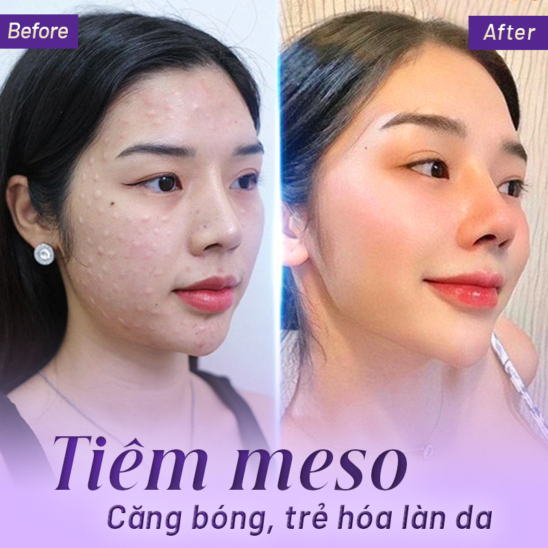 bảng giá tiêm meso