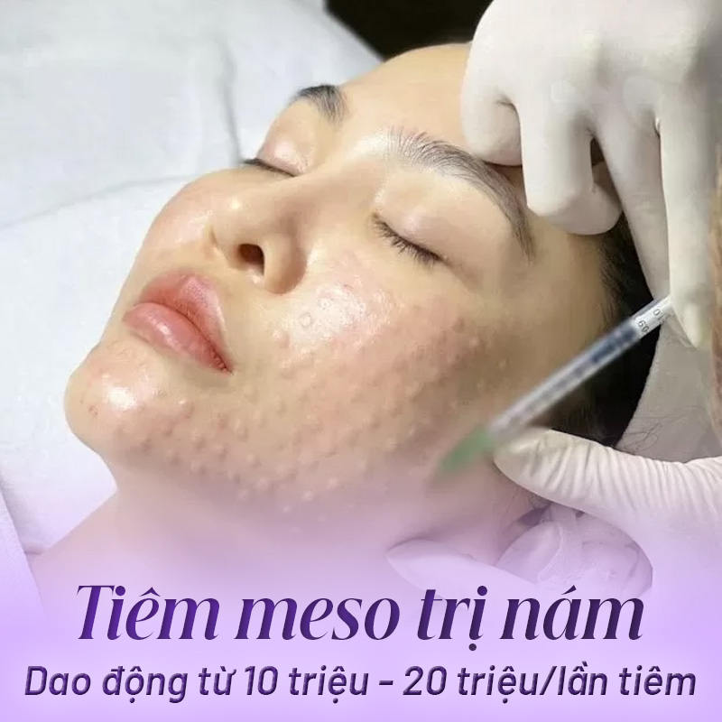 meso extra giá bao nhiêu