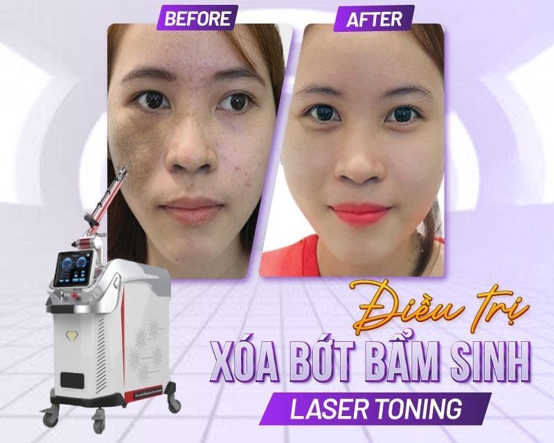 bắn tia laser trị bớt giá bao nhiêu