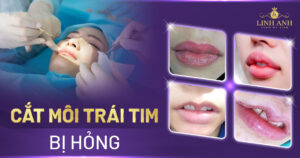 cắt môi trái tim bị hỏng - Viện thẩm mỹ quốc tế Linh Anh