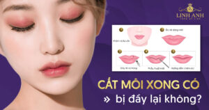 cắt môi xong có bị đầy lại không