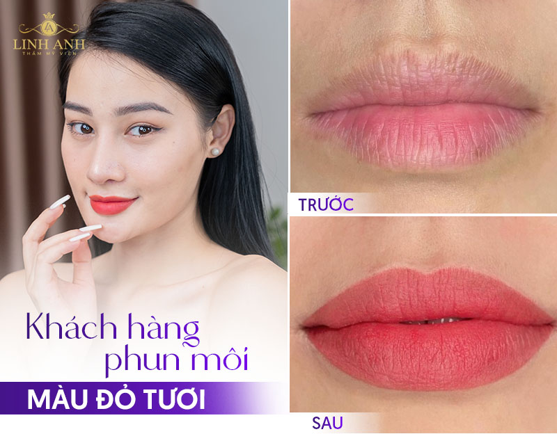 cấy môi Diamond lips màu đỏ tươi