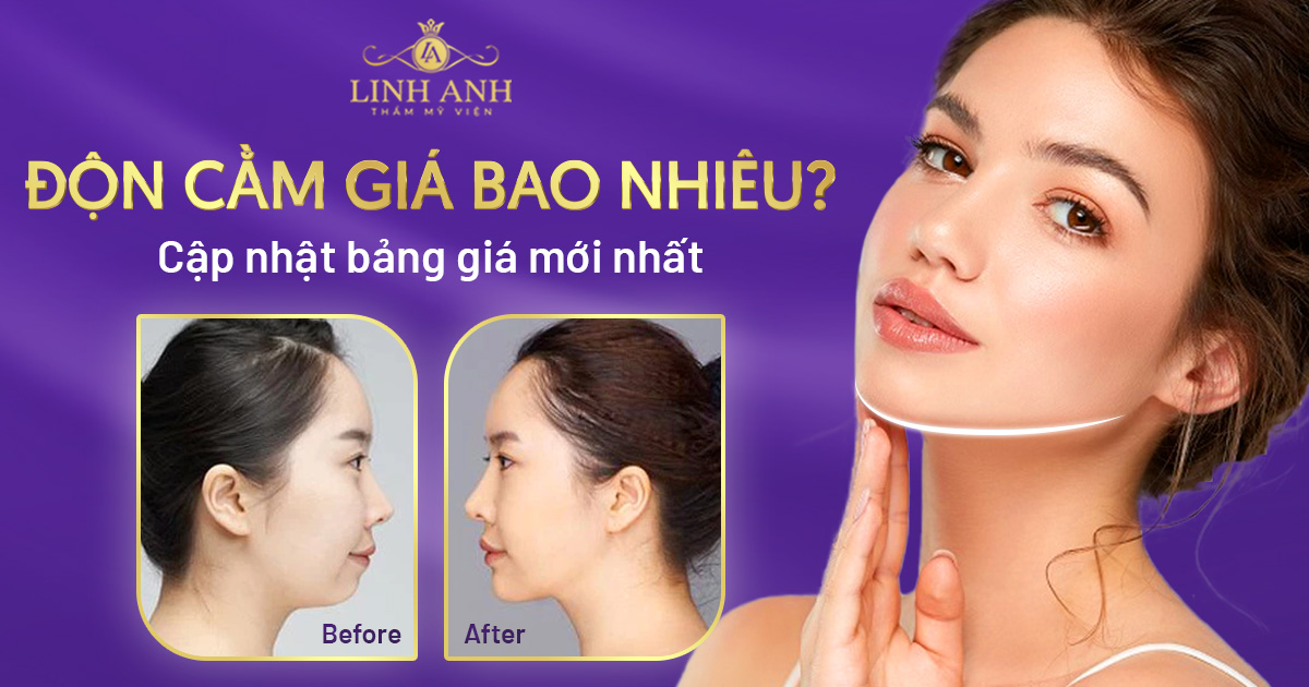 Chi phí độn cằm là bao nhiêu? Bảng giá độn cằm V line chuẩn nhất