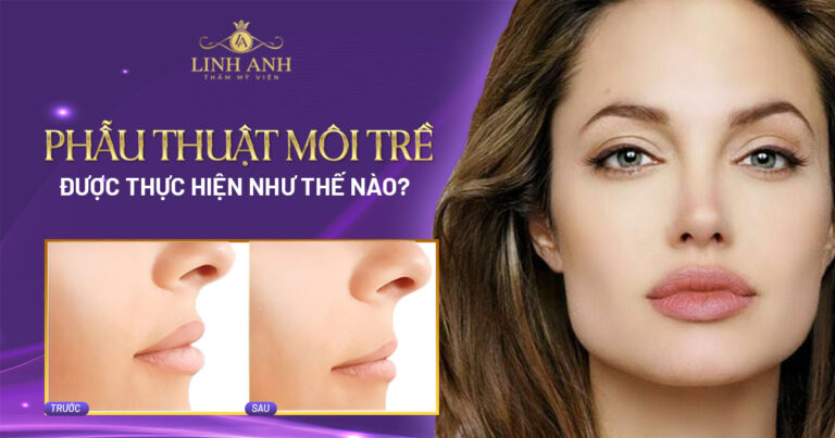 Môi trề là gì? Phẫu thuật môi trề được thực hiện như thế nào?