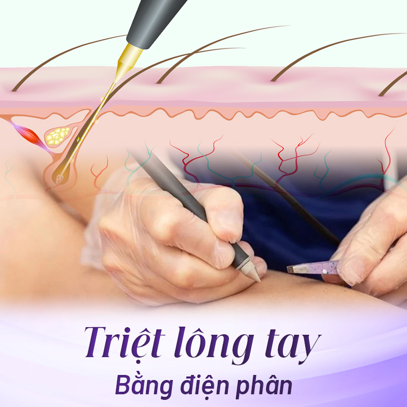 triệt lông tay nữ