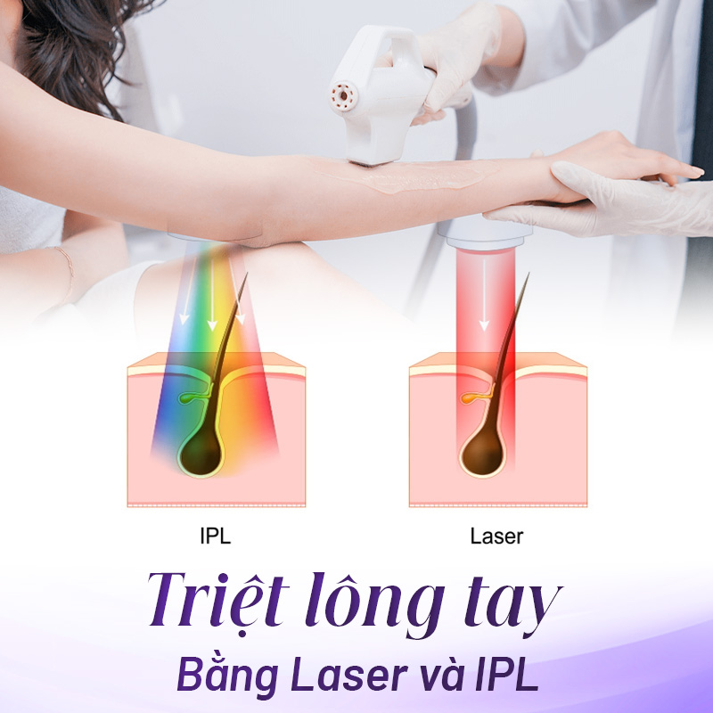 triệt lông tay tại Linh Anh