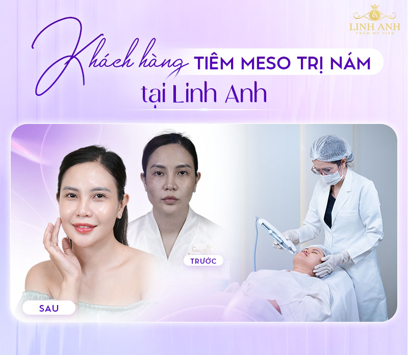 Trước và sau tiêm meso