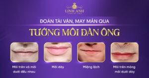 tướng môi đàn ông - Viện thẩm mỹ quốc tế Linh Anh