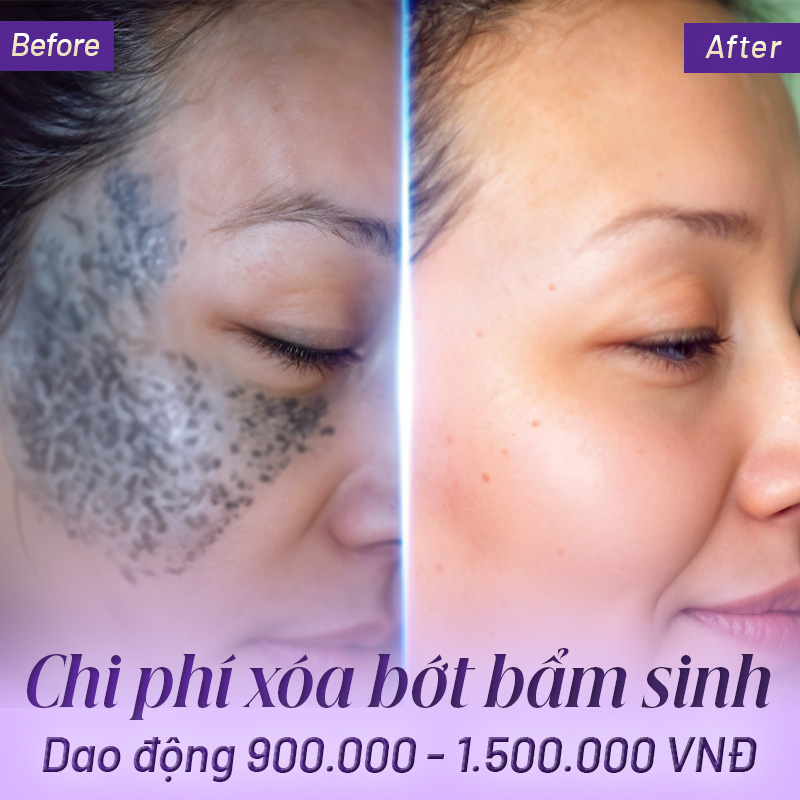 xoá vết bớt bao nhiêu tiền