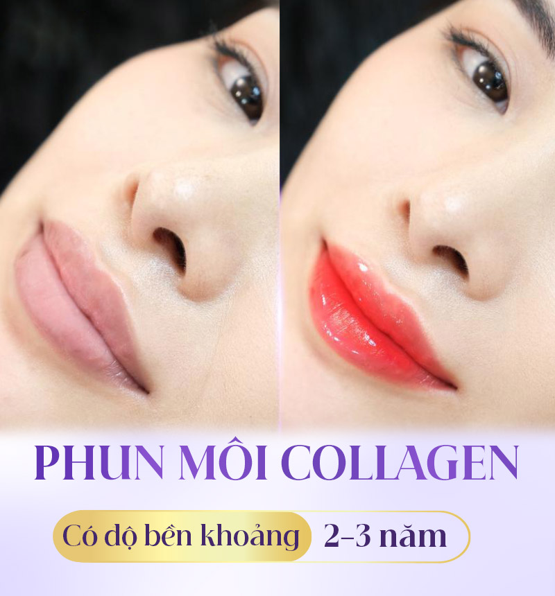 phun môi collagen giữ được bao lâu