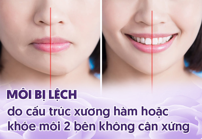 cách khắc phục môi lệch tại nhà