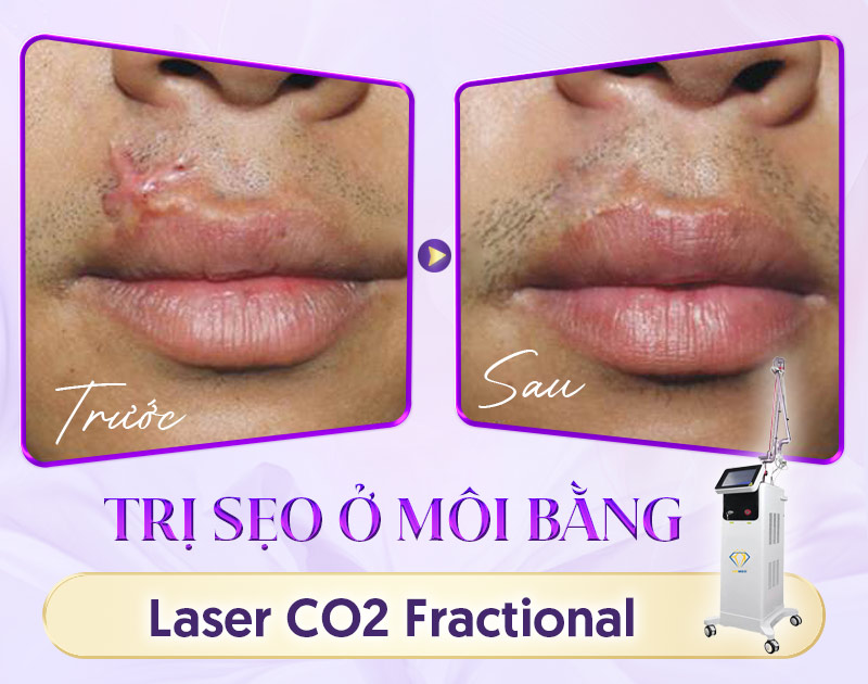 cách trị sẹo lồi ở môi lâu năm bằng laser CO2 Fractional