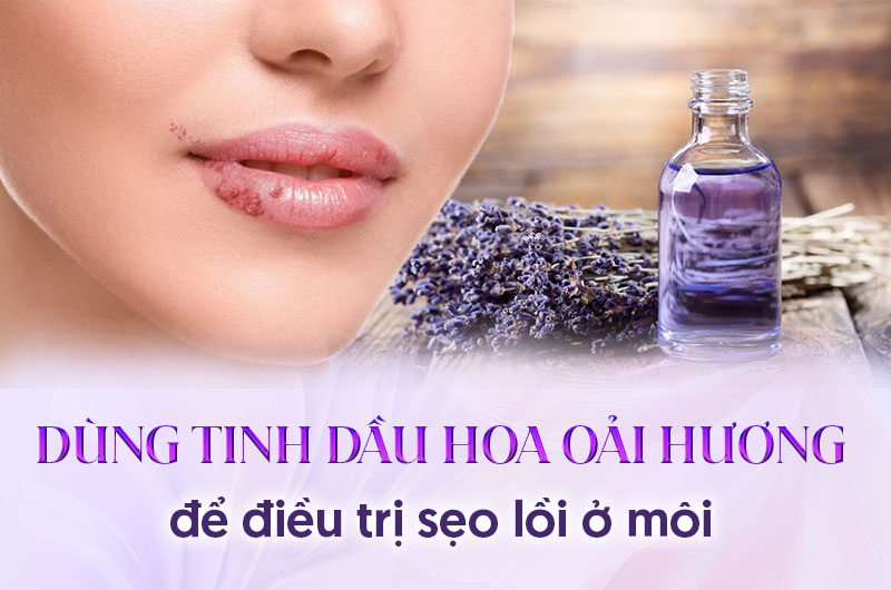 cách trị sẹo lồi ở môi bằng tinh dầu hoa oải hương