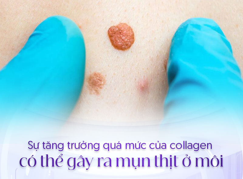 điều trị mụn thịt ở môi