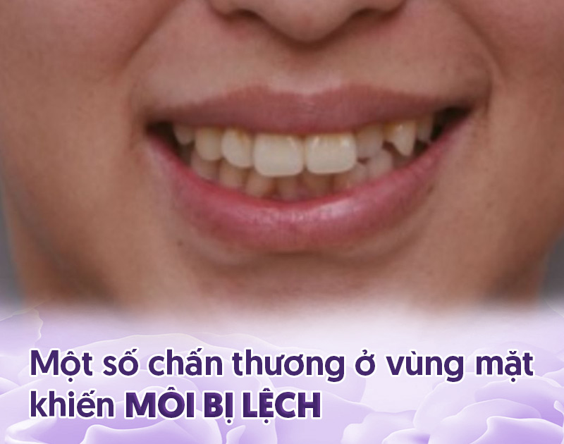 khắc phục tình trạng môi bị lệch