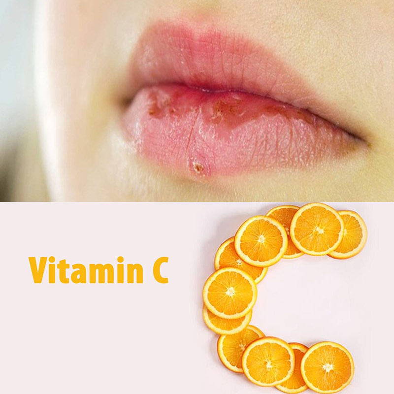 khô môi thiếu vitamin gì