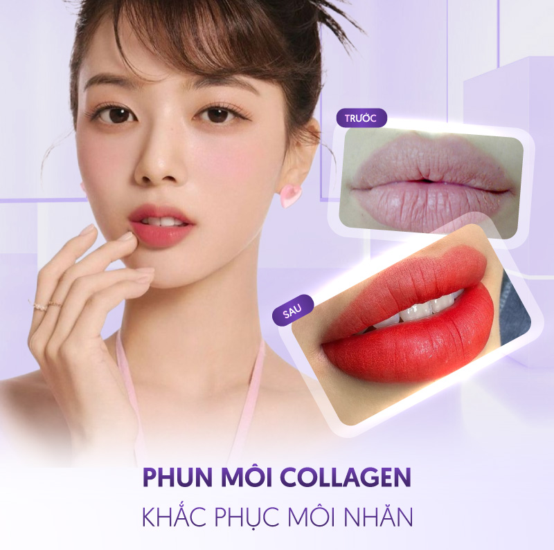 Phun môi collagen khắc phục môi nhăn