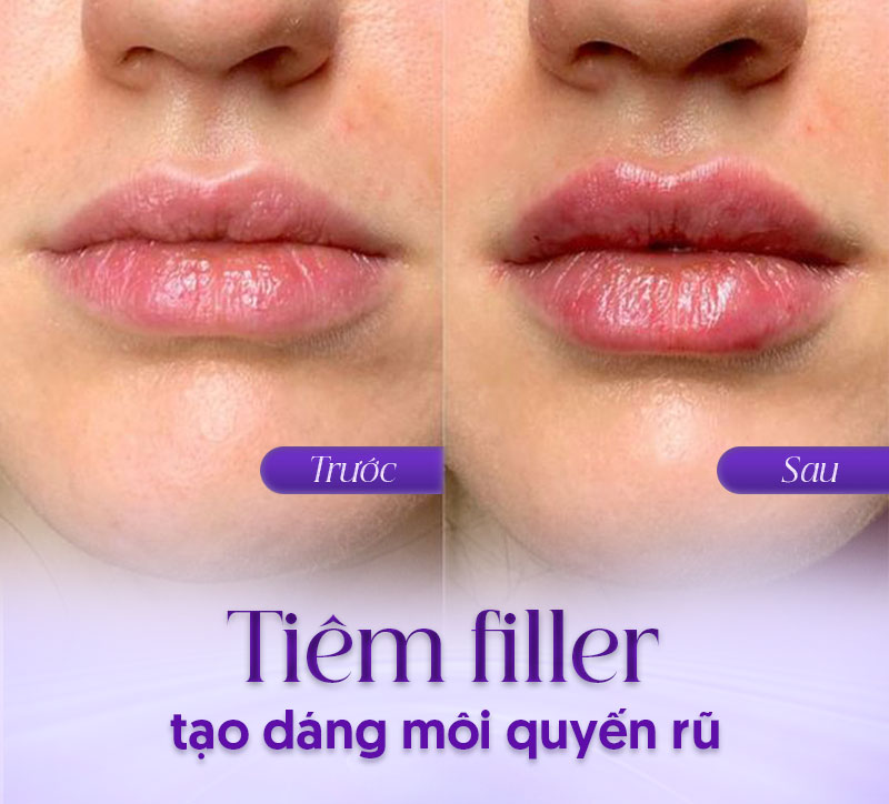 Tiêm filler tạo dáng môi quyến rũ.