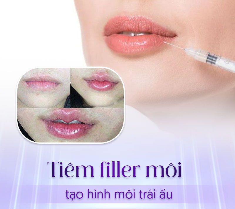 Tiêm Filler môi để tạo hình dáng môi trái ấu.