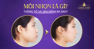 môi nhọn - Viện thẩm mỹ quốc tế Linh Anh