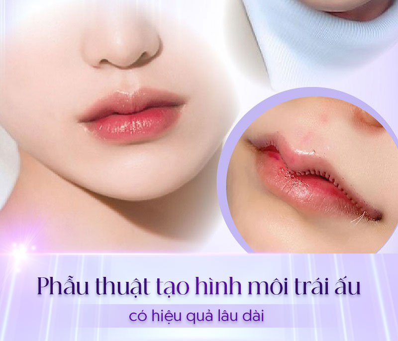 Phẫu thuật chỉnh hình môi sừng trâu (môi quả ấu).