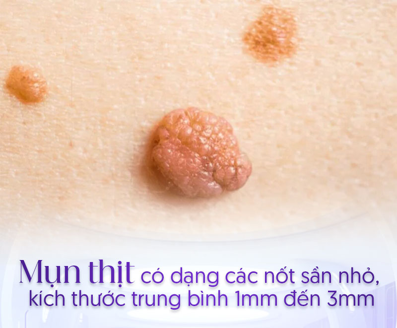 mụn thịt ở môi có trị được không