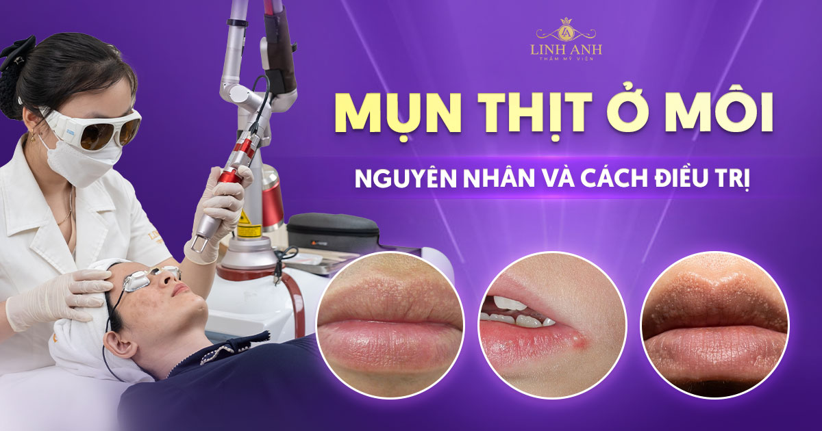 Mụn thịt ở môi – Nguyên nhân và cách điều trị hiệu quả