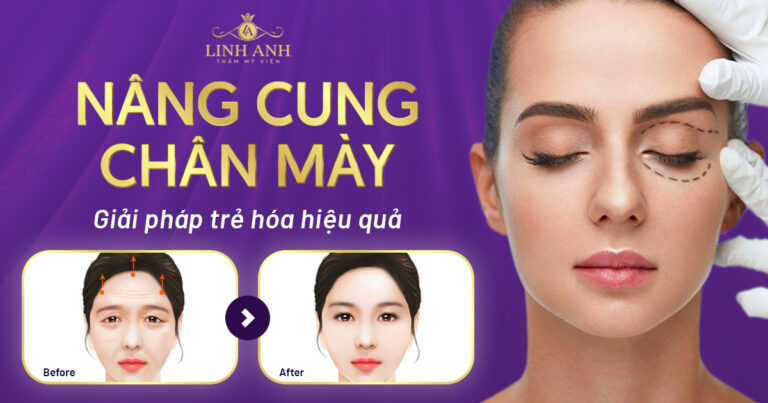 Có nên nâng cung chân mày không? Những điều cần biết về nâng cung chân mày