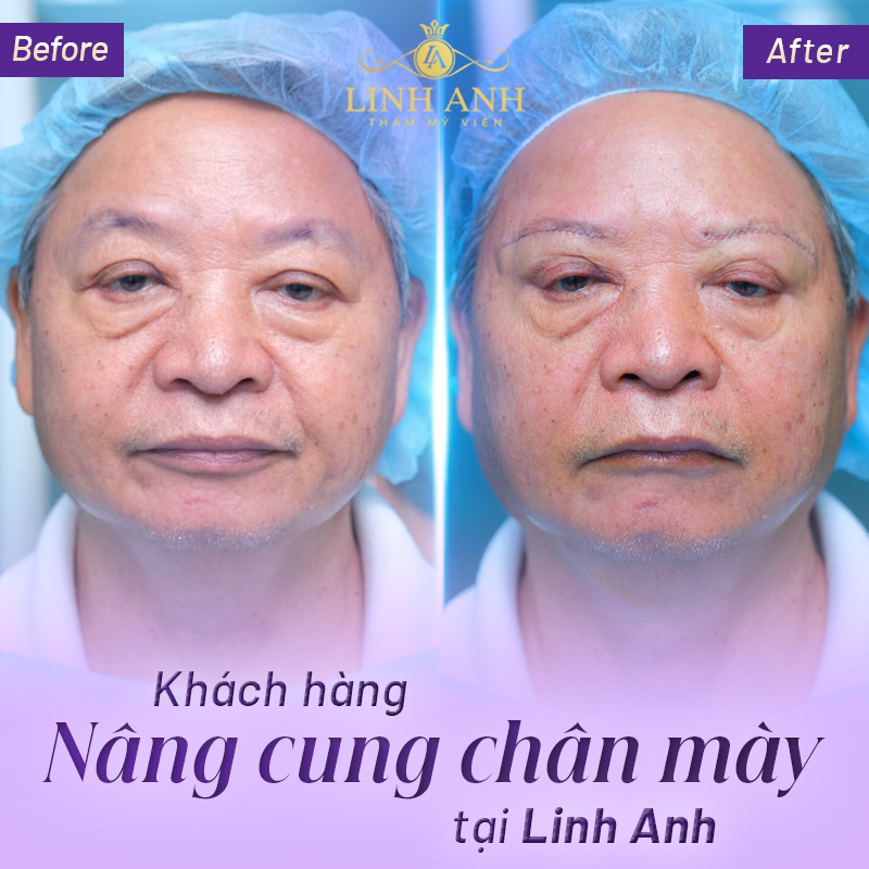 nâng cung chân mày là sao