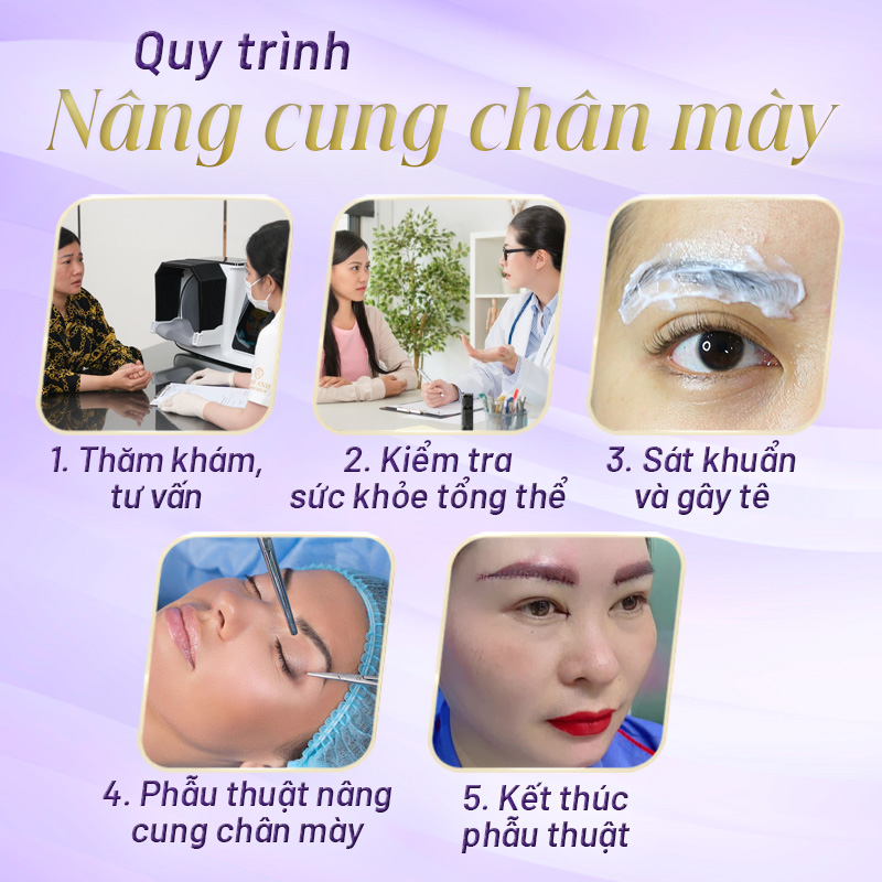 nâng cung chân mày trên