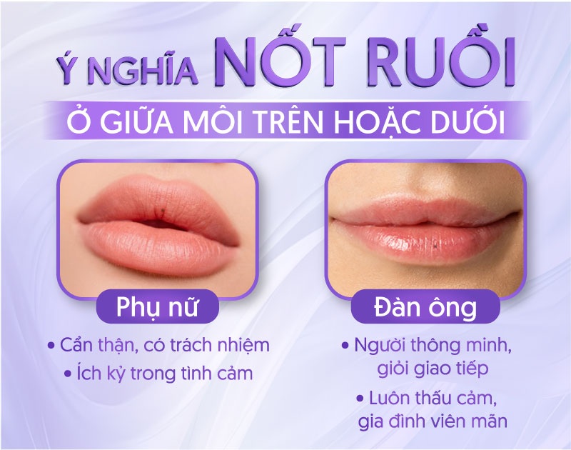 Nốt ruồi ở giữa môi trên hoặc dưới